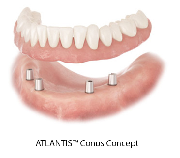 Atlantis conuss