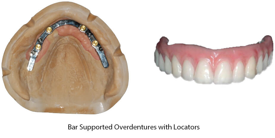 pro art bad supported overdentures with locators