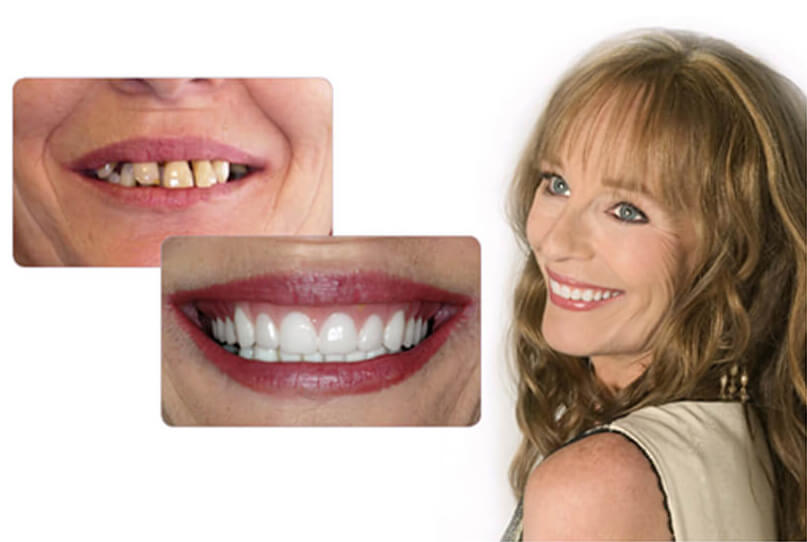 pro art conventional denture