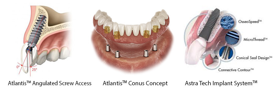 pro art dentsply sirona implants