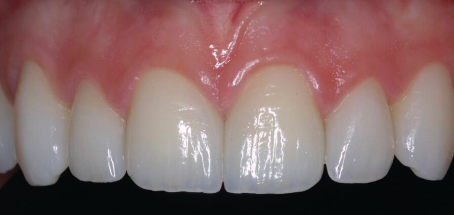 pro art feldspathic veneers