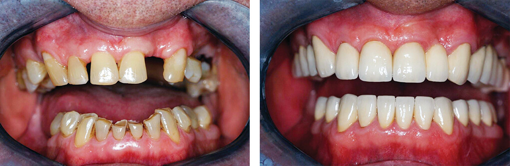 pro art full mouth reconstruction