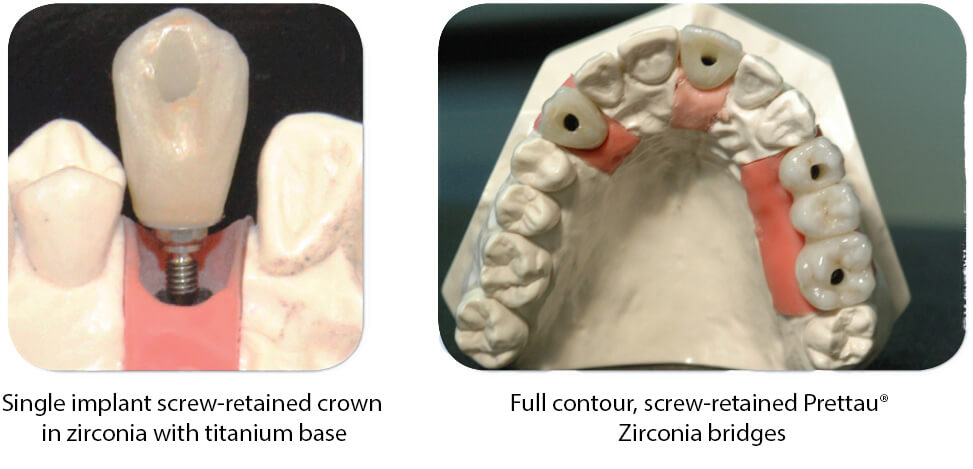 pro art single implant and full contour