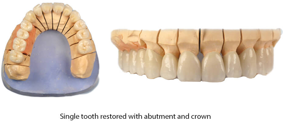 pro art single tooth restored with abutment and crown