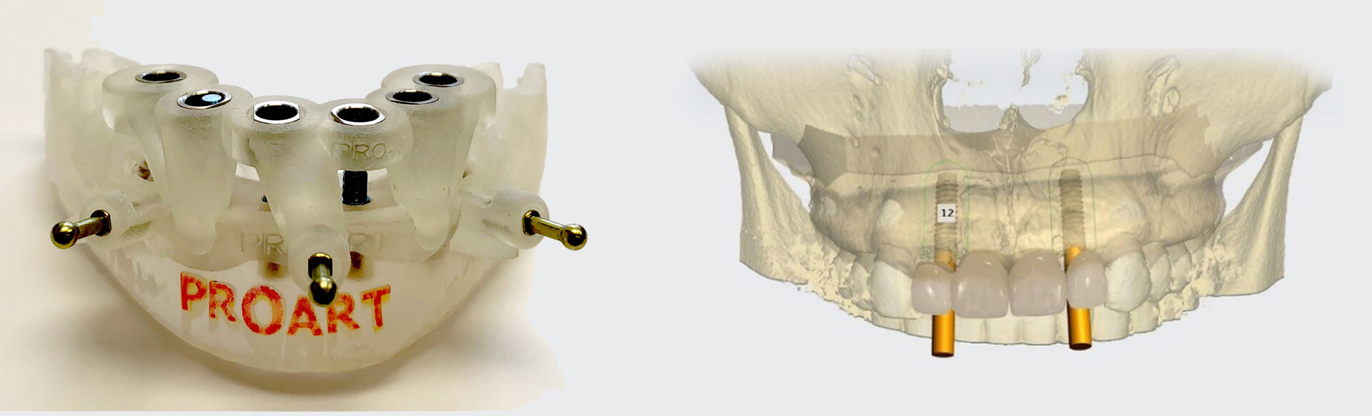 pro art surgical guides and restoration