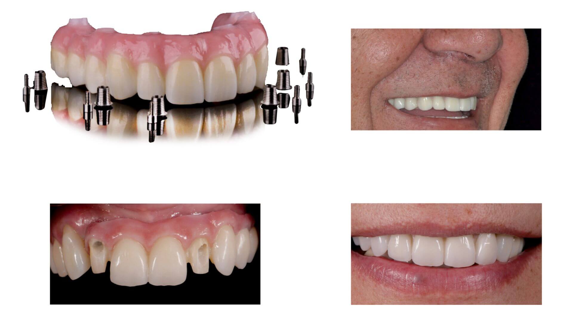 pro art the prettau® zirconia process includes a plastic prototype