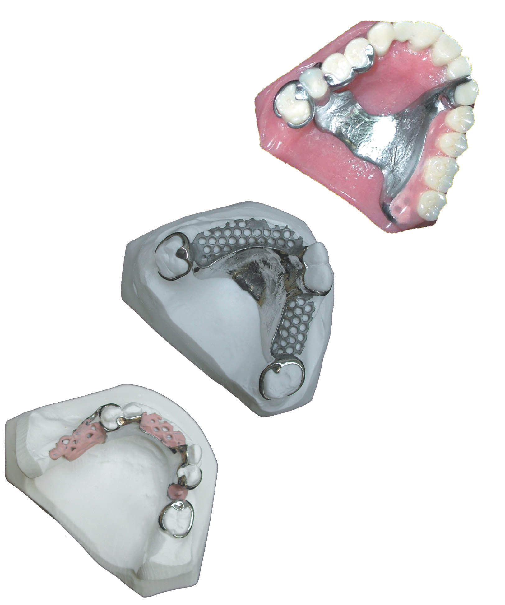 pro art titanium cast partials