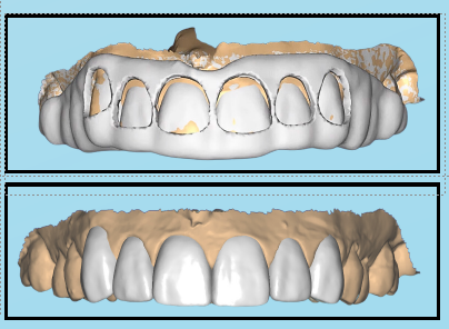 crown lengthening treatment