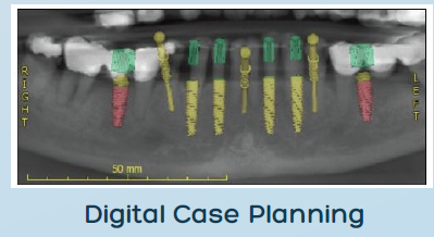 restoration screw implants dental